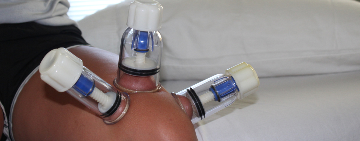 Cupping- a form of structural therapy